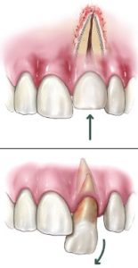 Dental Trauma picture